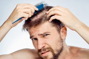 A Complete Guide to Hair Loss: Signs of Male Pattern Baldness