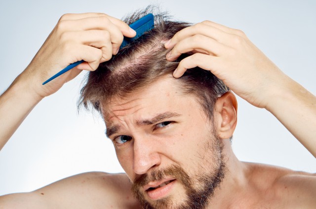 A Complete Guide to Hair Loss: Signs of Male Pattern Baldness