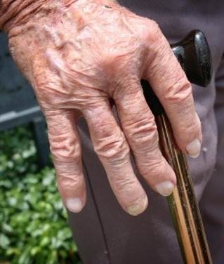 arthritis